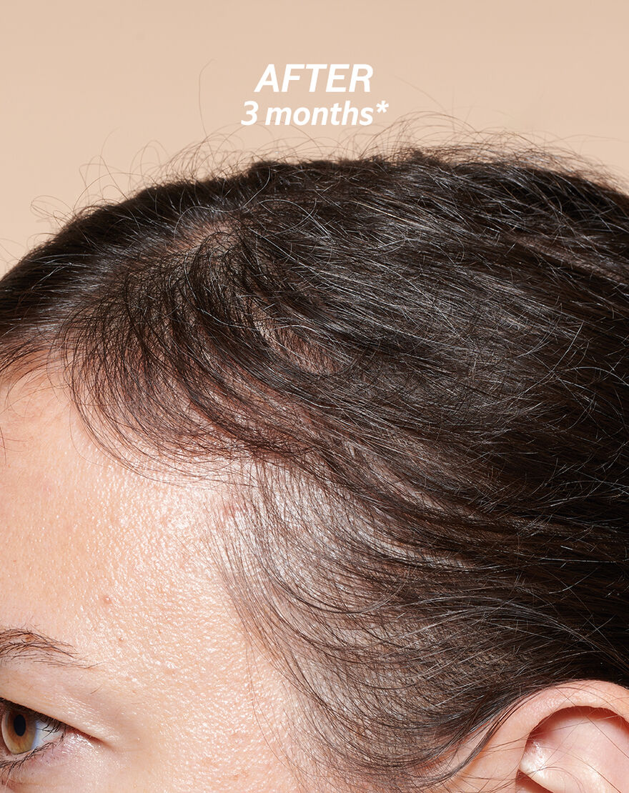 Anti-Hair Loss Serum anti hair loss serum