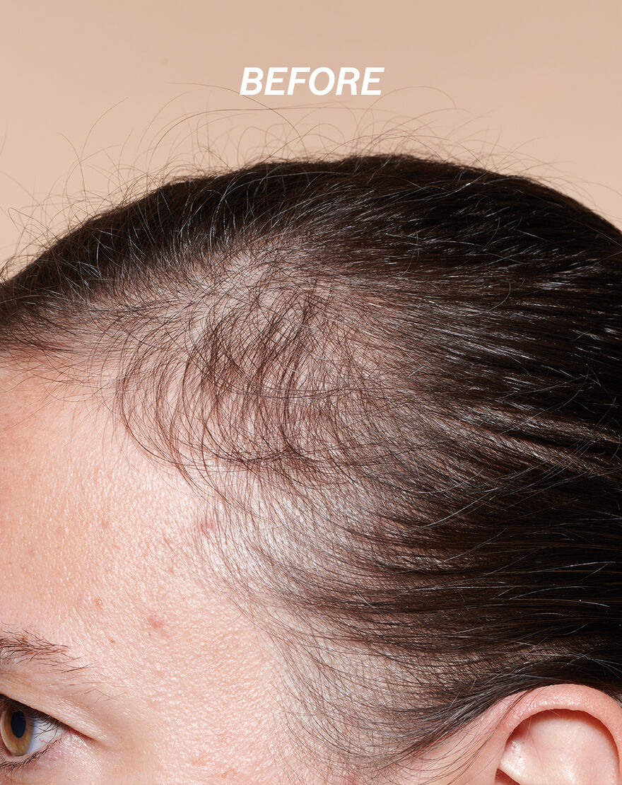 Anti-Hair Loss Serum anti hair loss serum